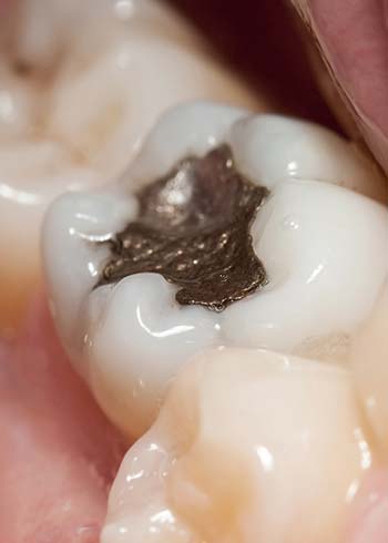 Mercury Exposure From Dentistry